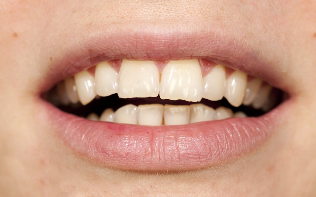 ¿Cuáles son las causas y consecuencias del desgaste dental?