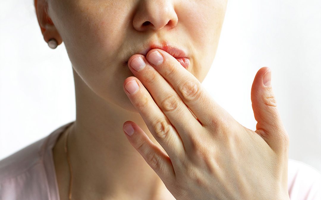 ¿Cómo puedes prevenir y curar las aftas bucales?