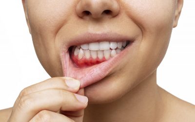 ¿Cómo puedes distinguir la gingivitis de la periodontitis?