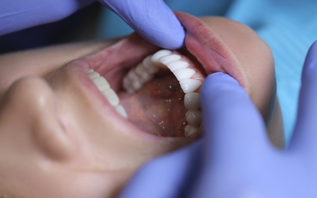 ¿Qué problemas bucodentales pueden solucionar las carillas dentales?