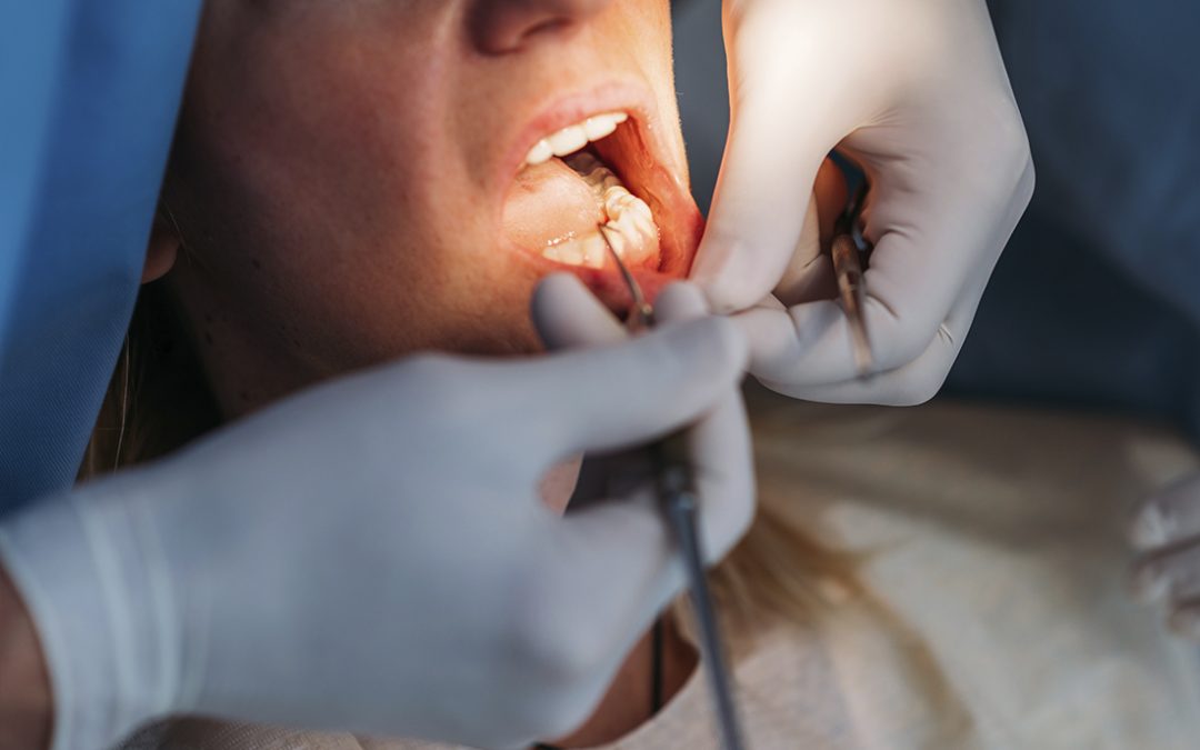 ¿Puedo ponerme implantes dentales si padezco periodontitis?
