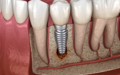 Periimplantitis: un desafío para la salud de los implantes dentales