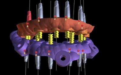 CirugÃa guiada en odontologÃa en A Coruña: innovación y precisión
