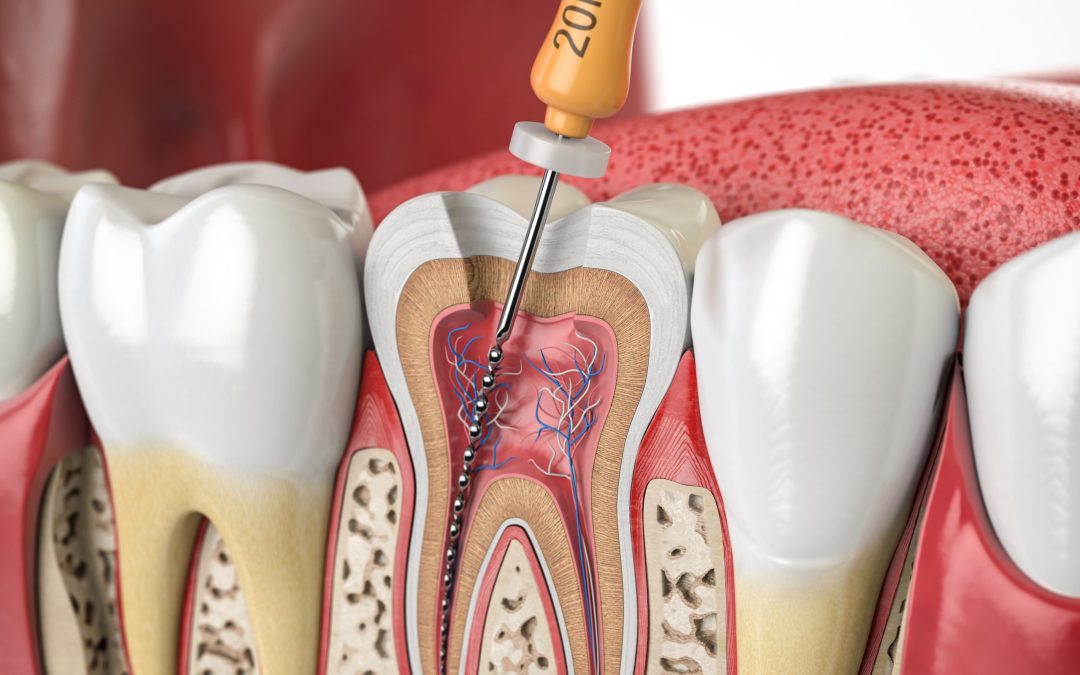 Diferencia entre empaste y endodoncia en A Coruña Clínica Dr. Plaza